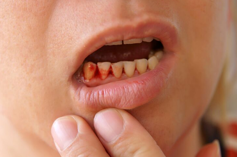 歯茎から血が出る