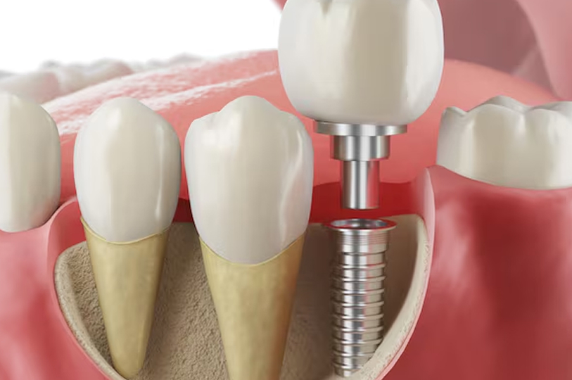 最小限でインプラント治療をしたい