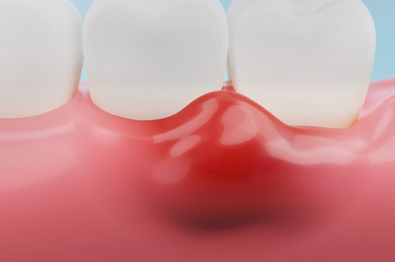 重度の歯周病だが歯を残したい