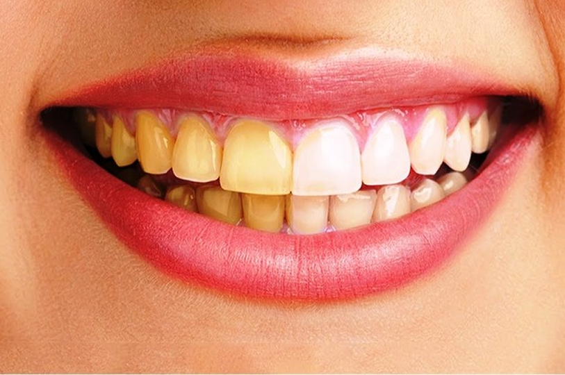 歯の黄ばみを落として白くしたい