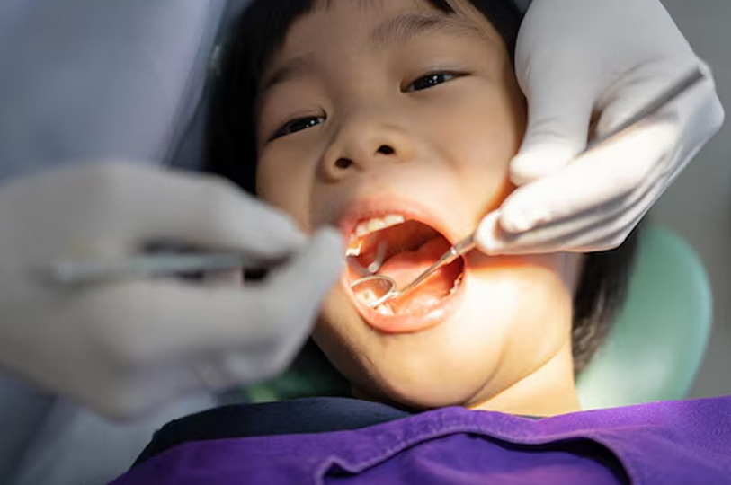 お子様のむし歯予防をしたい