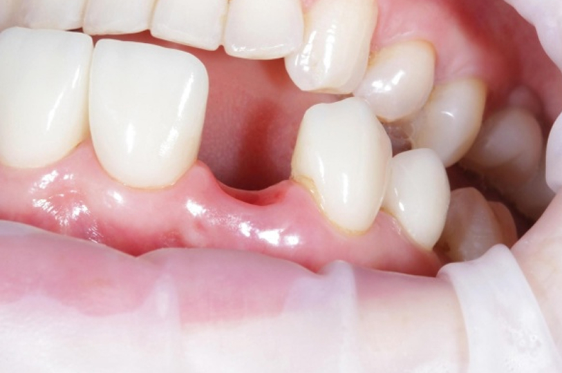 失った歯を自分の歯のように治したい