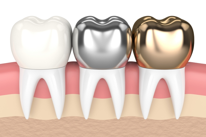 銀歯を白くしたい