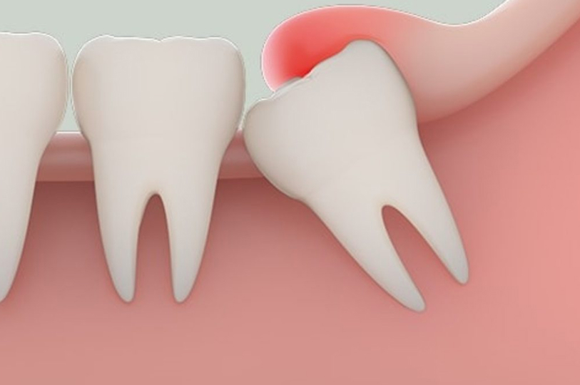 親知らず抜歯や口内炎の治療をしたい