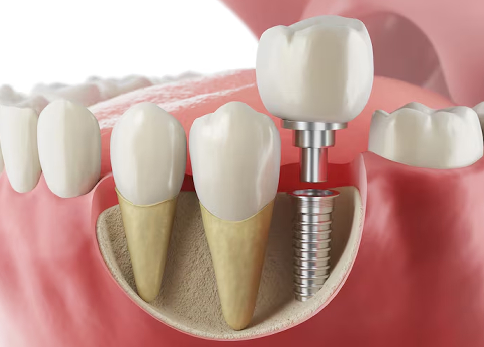 インプラント治療