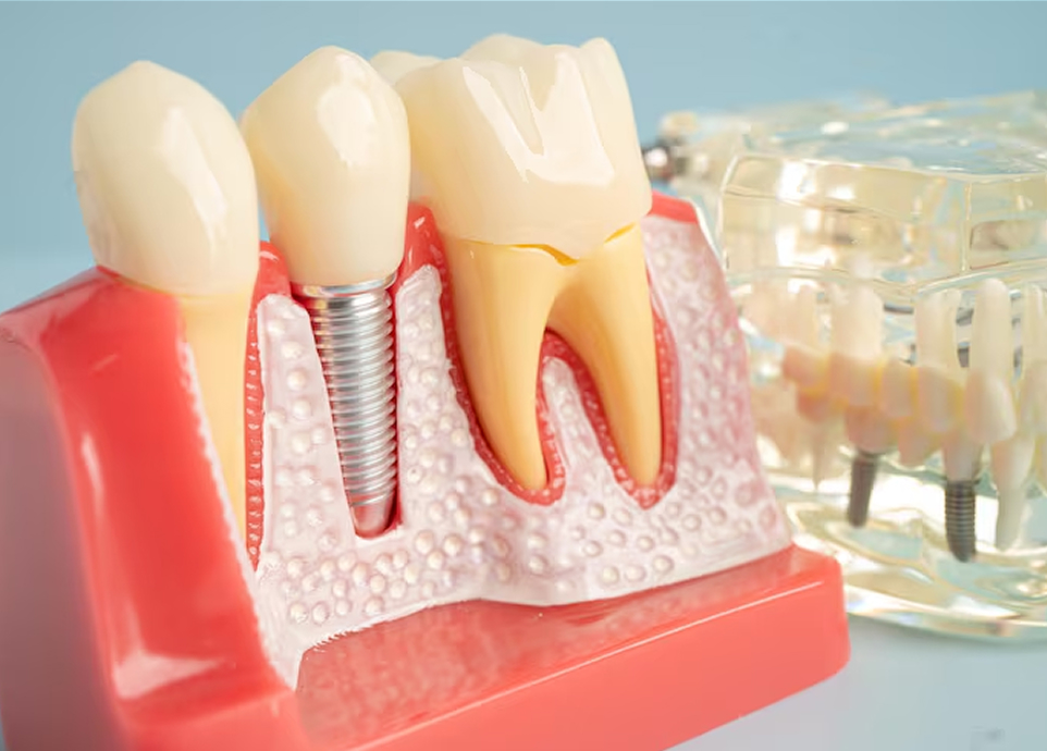 抜歯即時インプラント