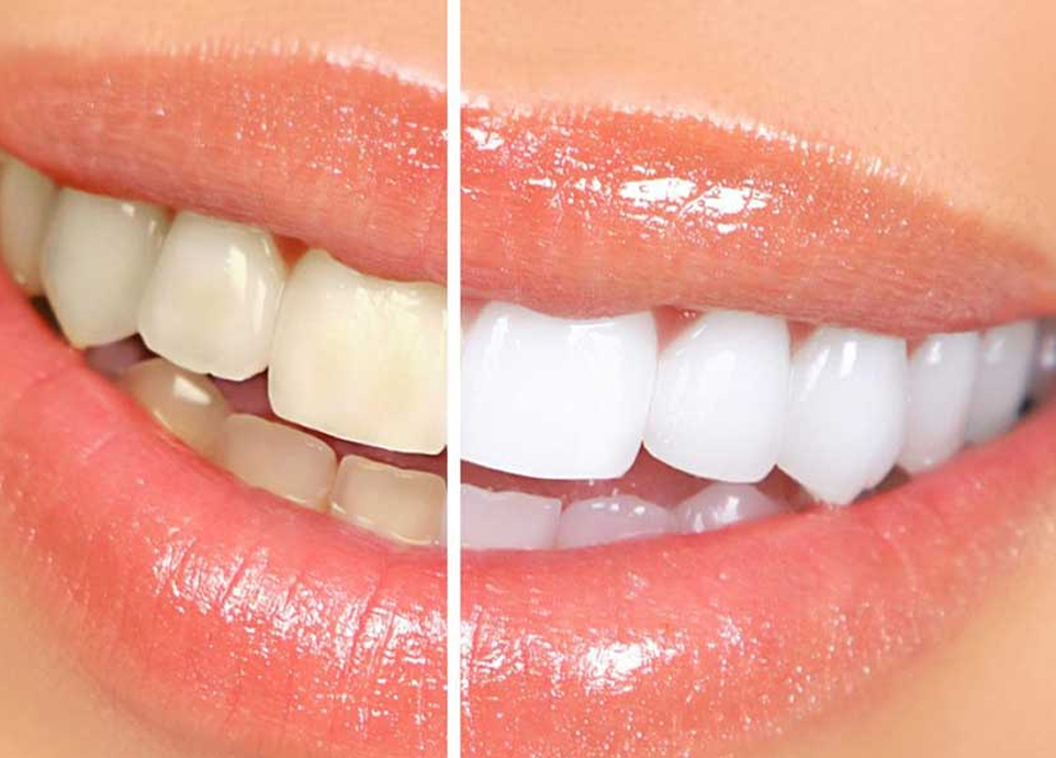 ホワイトニング