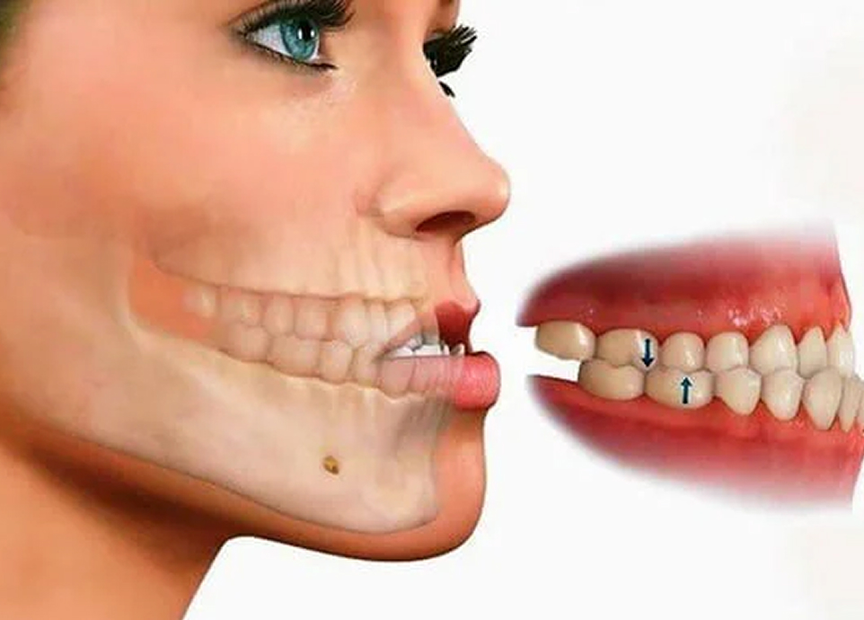 噛み合わせ治療