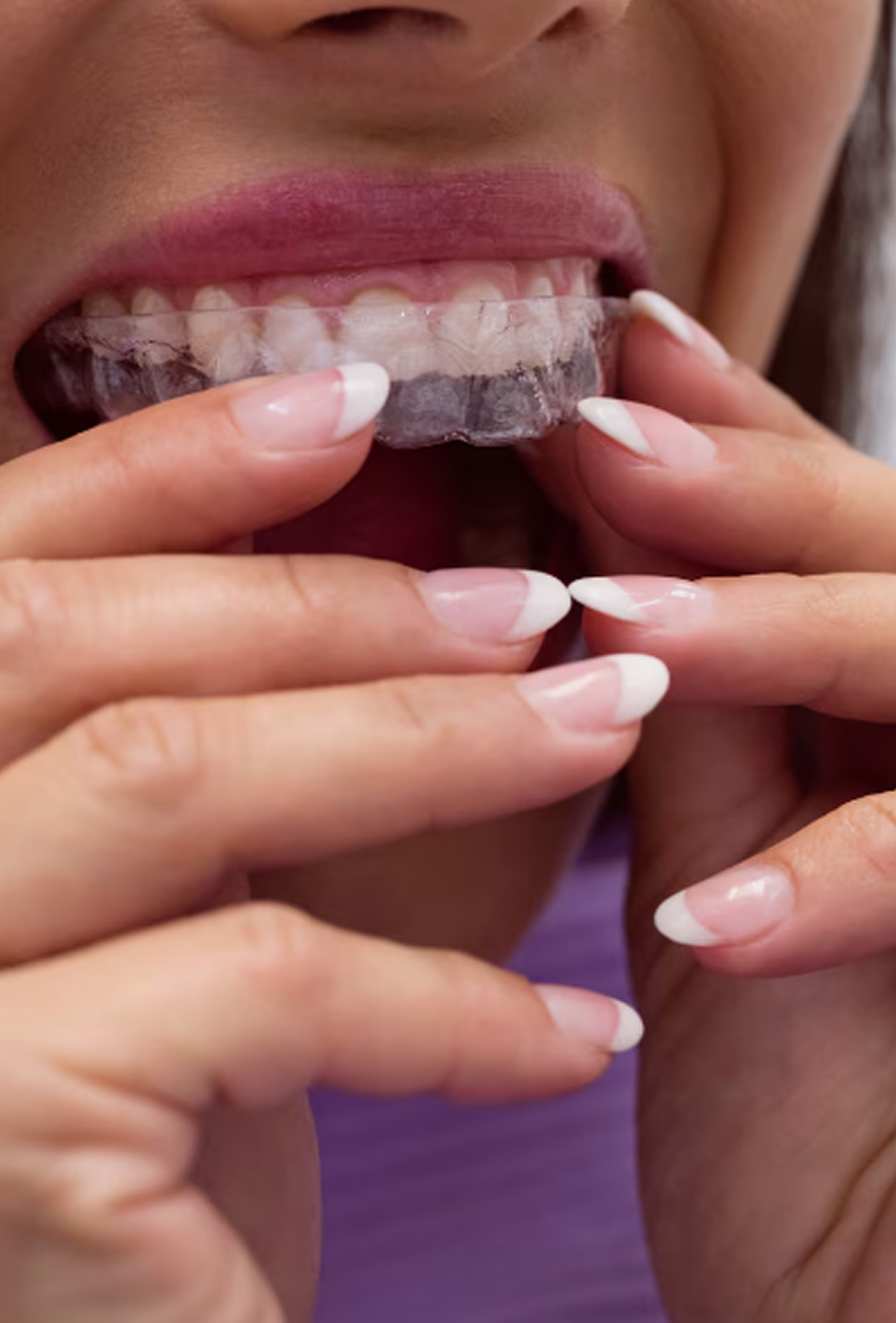 マウスピース矯正