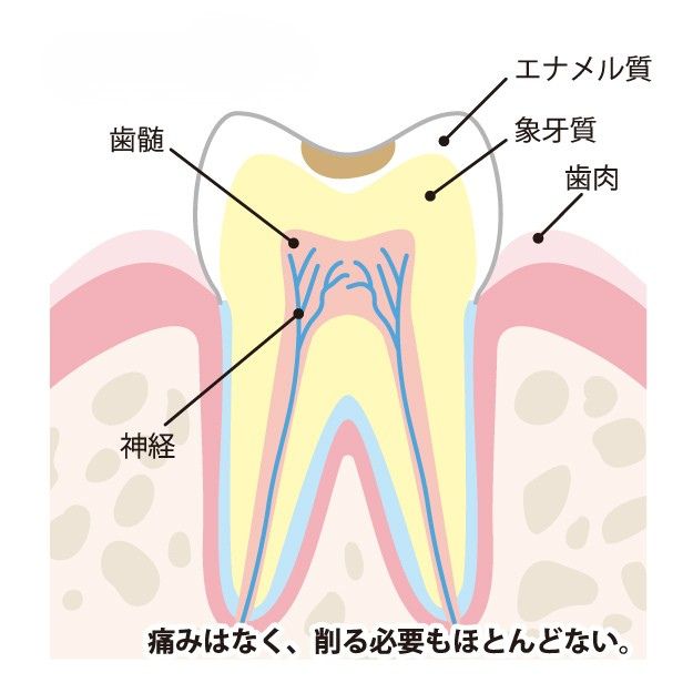 エナメル質のむし歯