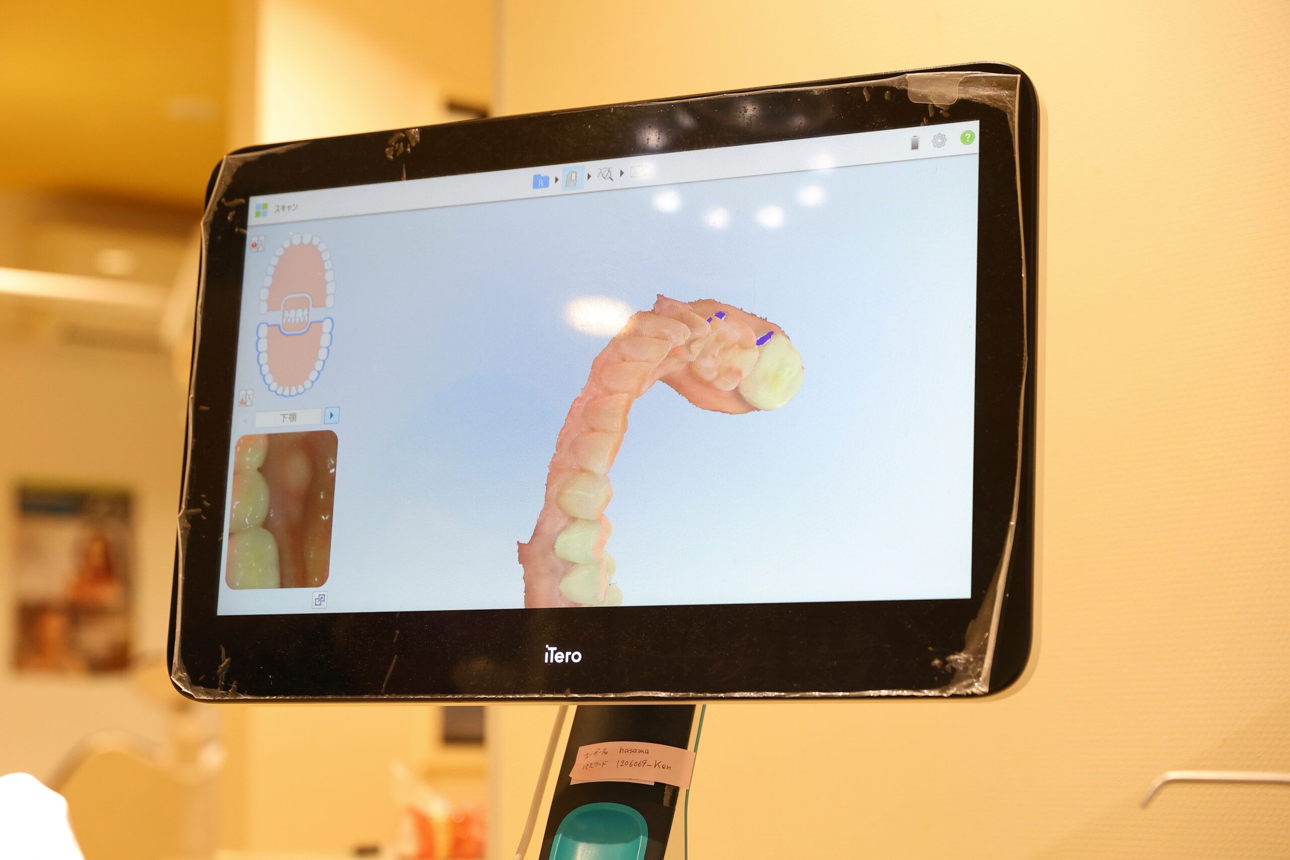 マウスピース矯正