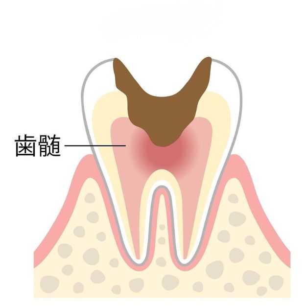 神経まで達したむし歯