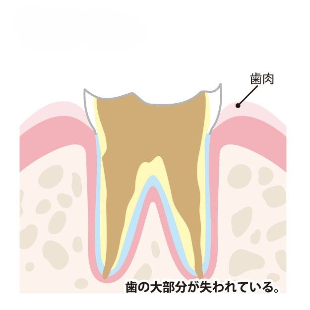 歯根だけ残った状態