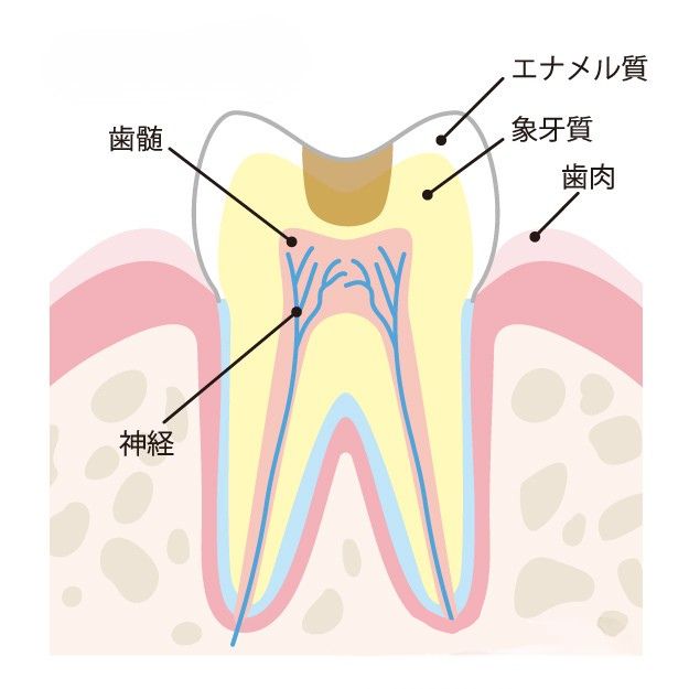象牙質のむし歯